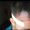 Kolors Health Care India - hair transplantation