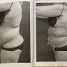 Sono Bello - Liposuction