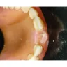 Aspen Dental - Denture repair