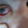 Acuvue - Severe eye damage from acuvue