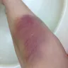 Quest Diagnostics - venipuncture malpractice that, caused severe bruises etc