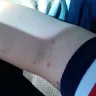 BioLife Plasma Services - tiny little scratches on my arm - ankeny iowa