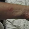 Priceline.com - bed bugs and my bites in my las vegas, nv hotel arizona charlie's