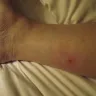 Priceline.com - bed bugs and my bites in my las vegas, nv hotel arizona charlie's